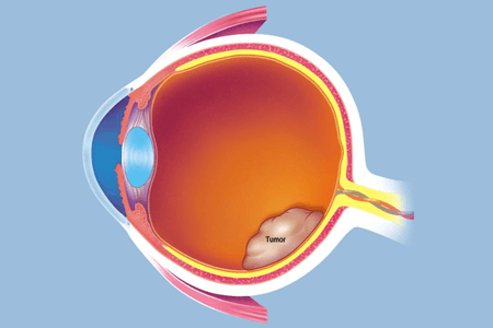 撅眼最快的治療方法是什么 需要如何防止復(fù)發(fā)？