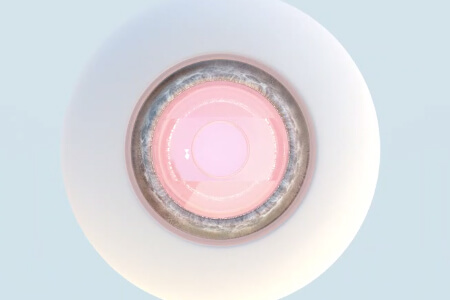 【史上最全】一文介紹清楚ICL和依鏡PRL的區(qū)別