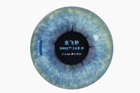 震驚！全飛秒手術(shù)后又近視了？專家教你這樣做