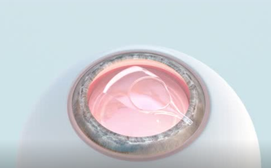 近視2000度應(yīng)該選擇人工晶體植入嘛？